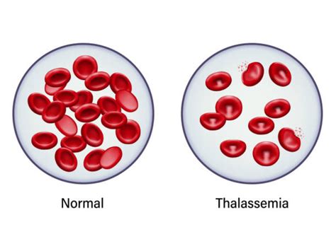 beta thalassemia anemia|Thalassemia .